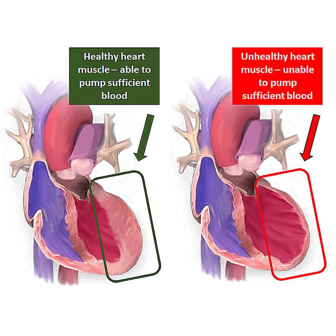 Congestive Heart Failure CarePlanIt